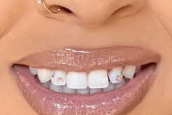 how to apply tooth gems at home using DIY tooth gems kit